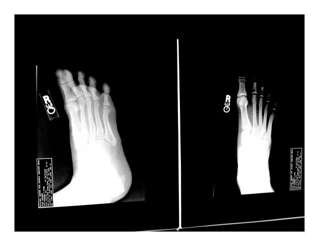 Foot xray